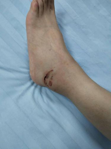 男子在湖边被蛇咬伤,男子在湖边被蛇咬伤视频